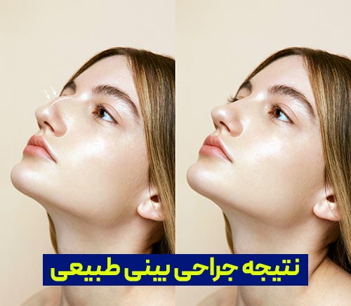 نتیجه جراحی بینی
