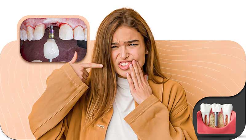 افتادن ایمپلنت