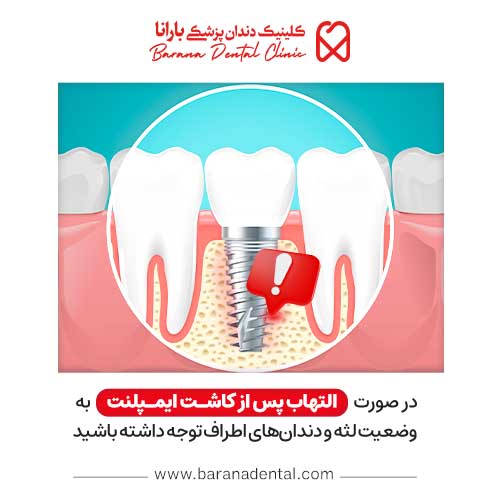 التهاب بعد از ایمپلنت